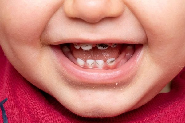 Sâu răng ở trẻ: Nguyên nhân - dấu hiệu nhận biết và cách hạn chế sâu răng ở trẻ 2