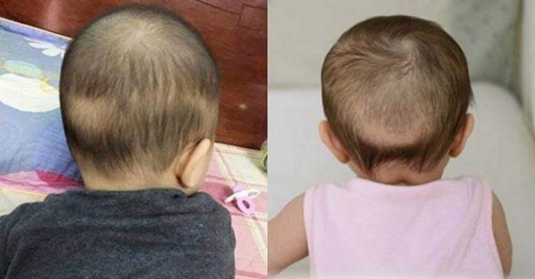 Rụng tóc vành khăn ở trẻ: Nguyên nhân, dấu hiệu và cách điều trị 1